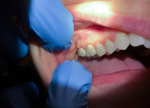 Best Emergency Dental Care for Broken or Chipped Teeth in Ranlo, NC